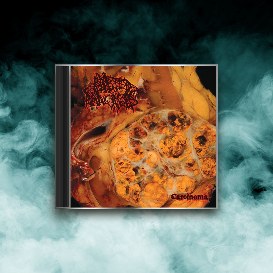 Blasted Pancreas - Carcinoma (CD)