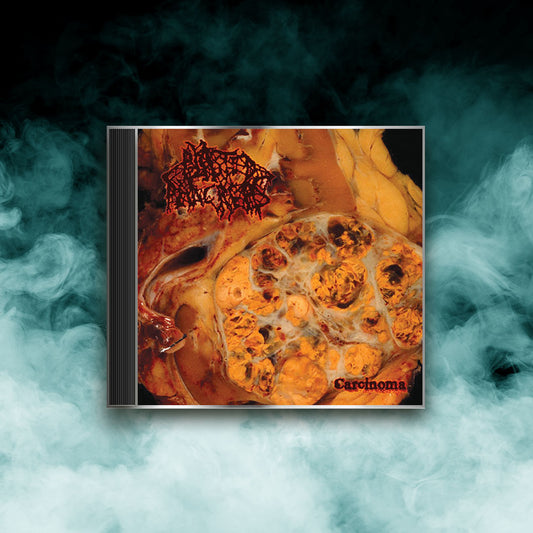 Blasted Pancreas - Carcinoma (CD)