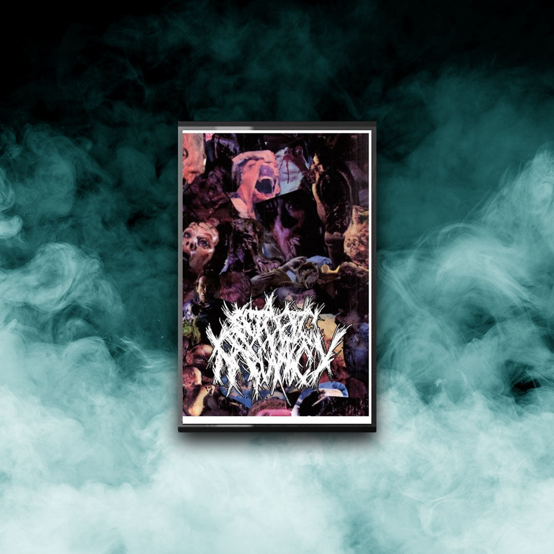 Ectopic Pregnancy - Transorbital Tracheal Intubation (Tape)